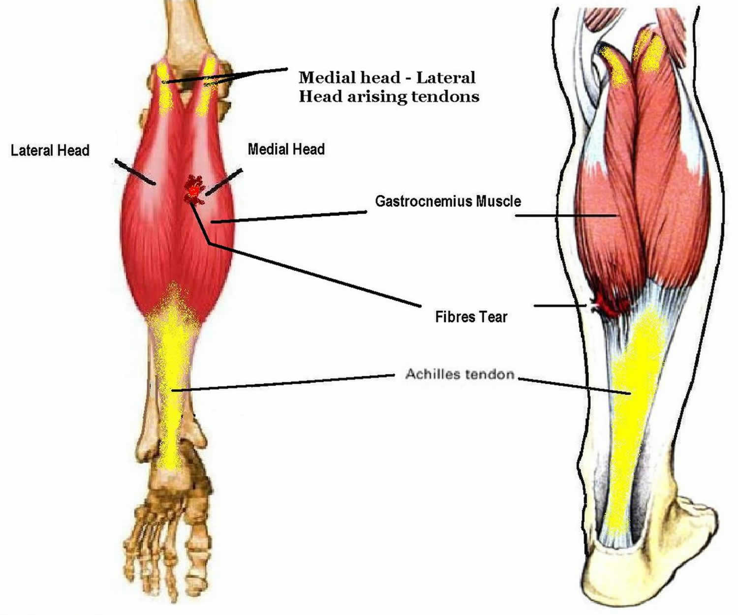 Anatomia do músculo gastrocnêmio medial tennis leg