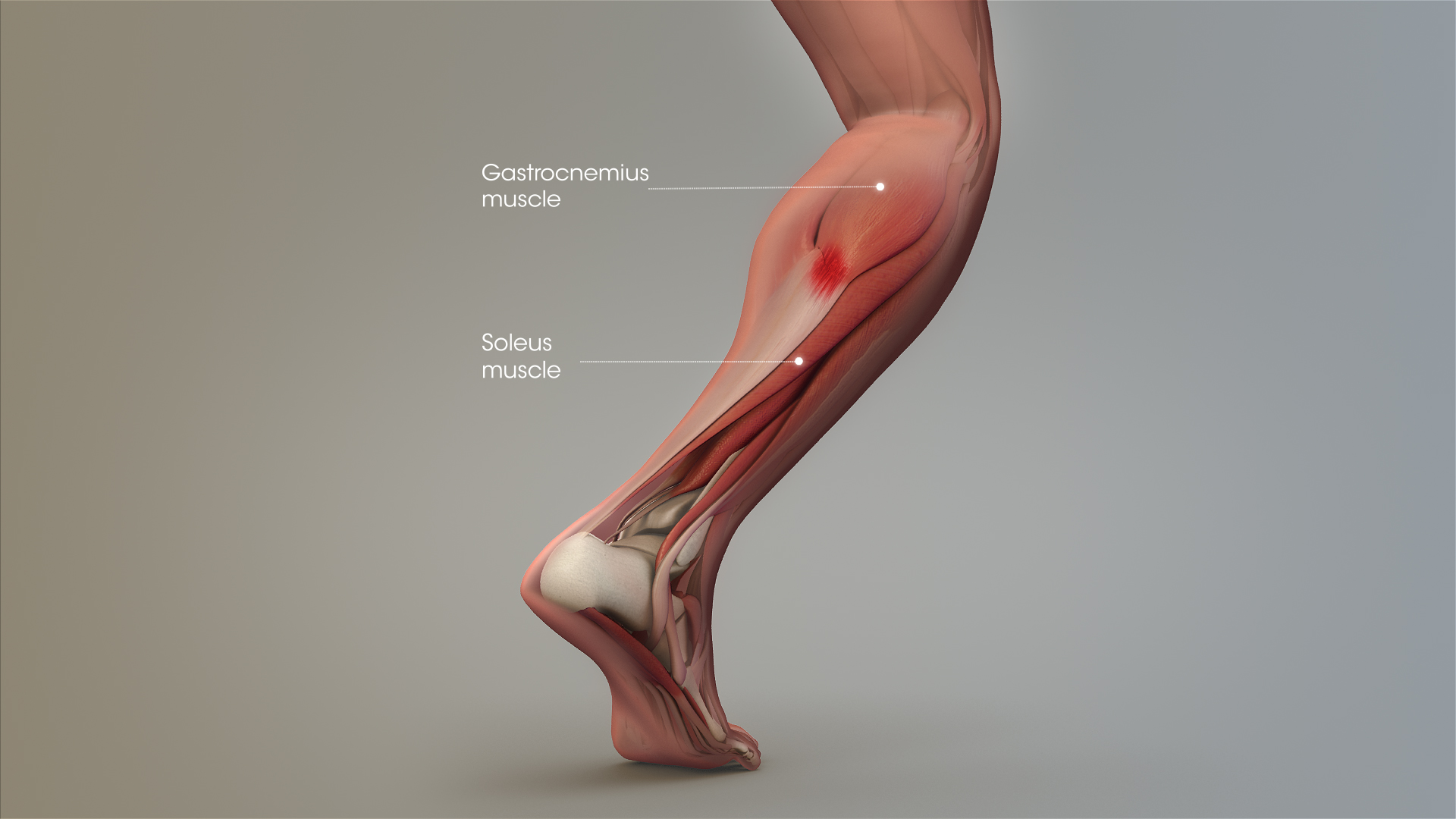 Tennis leg anatomy sagittal illustration