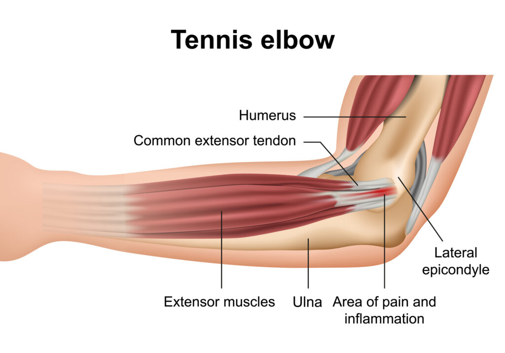 Anatomy of tennis elbow